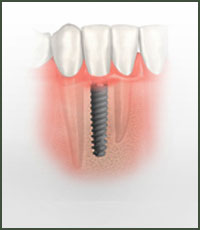 Dental Implants