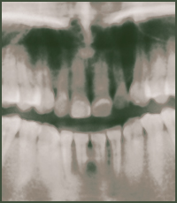 Root Canals