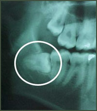 Wisdom Tooth Removal